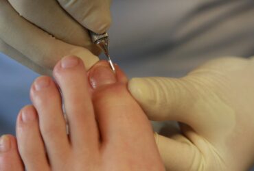 Wszystko o wrastających paznokciach u nóg – przyczyny, objawy, leczenie